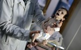 Thế giới rúng động trước em bé Syria gầy trơ xương nặng 2kg vì đói