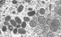 Chuyên gia bệnh truyền nhiễm: Bệnh đậu mùa khỉ không dễ lây lan, hoàn toàn có thể phòng ngừa