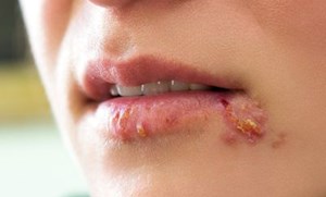 Nghiên cứu về nguồn gốc căn bệnh viêm da phổ biến do nhiễm virus herpes