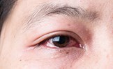 Đau mắt đỏ quay trở lại sau 2 năm “vắng bóng”, người dân cần lưu ý gì?